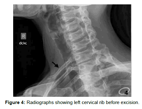 cervical rib causing occlusion of the subclavian artery and thoracic