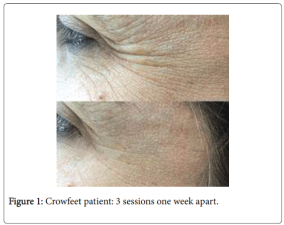 weight-loss-therapy-Crowfeet-patient
