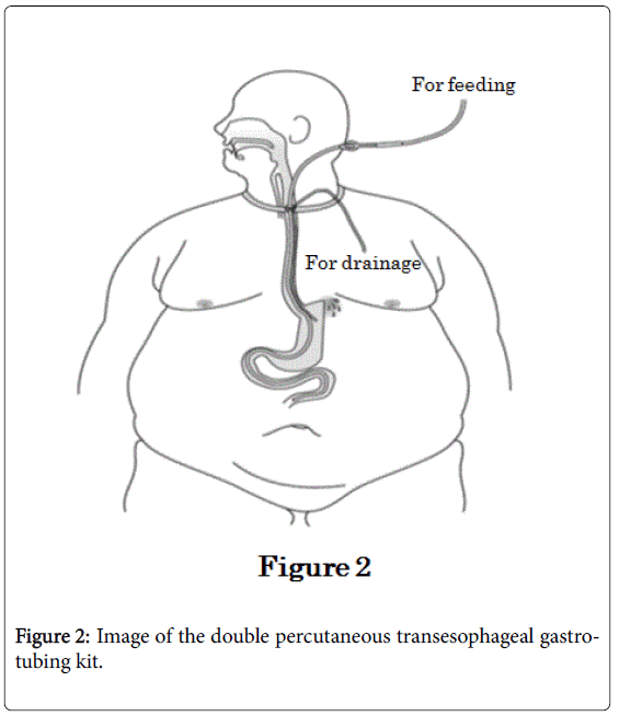 weight-loss-therapy-double-percutaneous