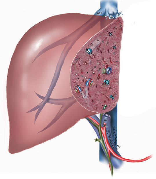 Hepatectomy Pictures 25