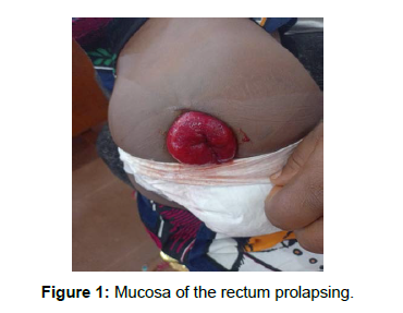 Journal of Paediatric Medicine & Surgery - Rectal Prolapse in Children: How  Effective is Non-Operative Treatment?