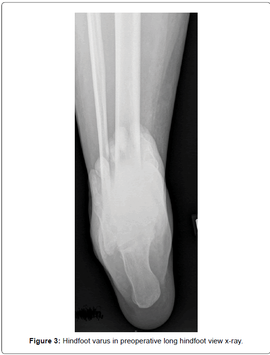 Results of Ankle Arthrodesis with Talarlock®-Plate in High Risk Patients Results of Ankle Arthrodesis with Talarlock®-Plate in High Risk Patients