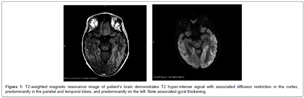 alzheimers-disease-parkinsonism-magnetic
