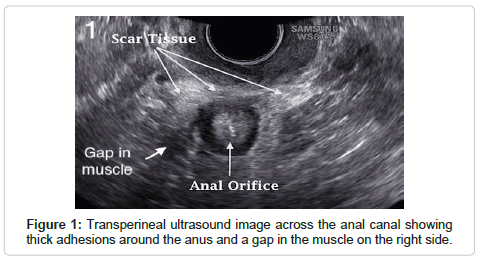 Anal scar tissue