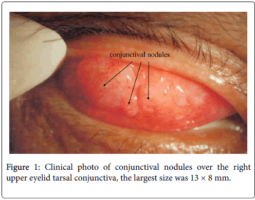 a case of igg4 related sclerosing disease presenting at the tarsal conjunctiva