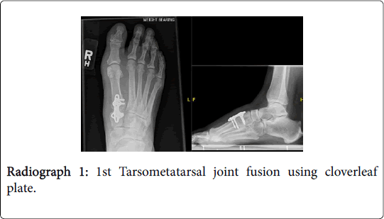 clinical-research-foot-ankle-joint-fusion