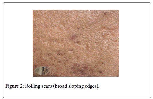 cosmetology-orofacial-Rolling-scars