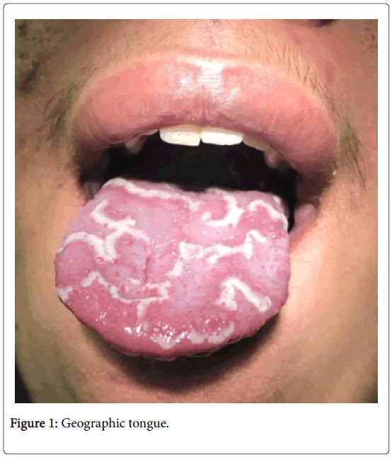 Geographic Tongue Lesions