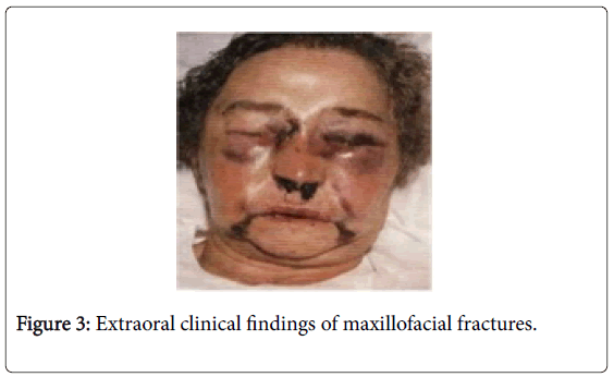 maxillo facial fractures Maxillo facial fractures