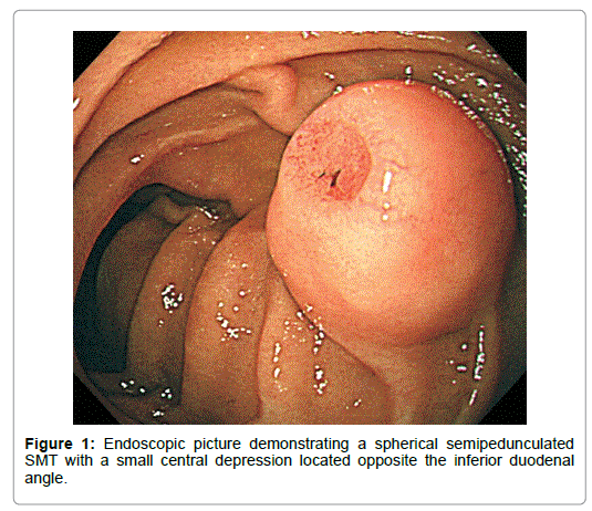 gastrointestinal-digestive-Endoscopic-picture