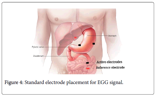 gastrointestinal-digestive-electrode