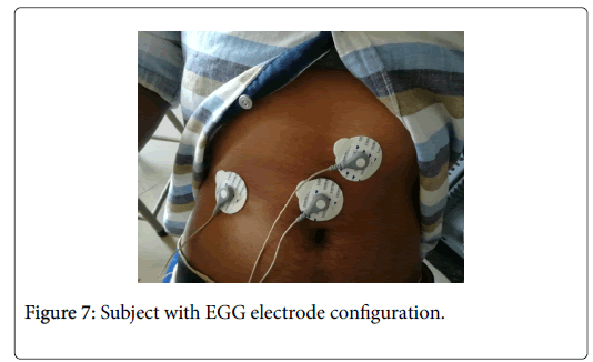 gastrointestinal-digestive-electrode-configuration