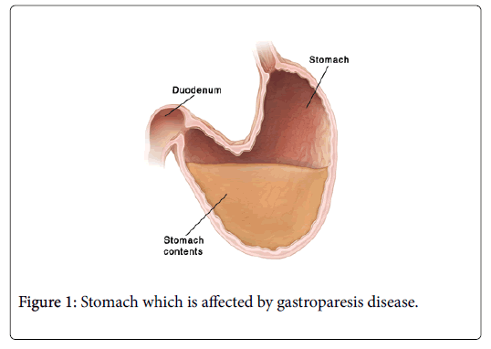 gastrointestinal-digestive-gastroparesis