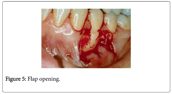 interdisciplinary-medicine-dental-science-flap-opening