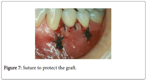 interdisciplinary-medicine-dental-science-suture-protect-graft