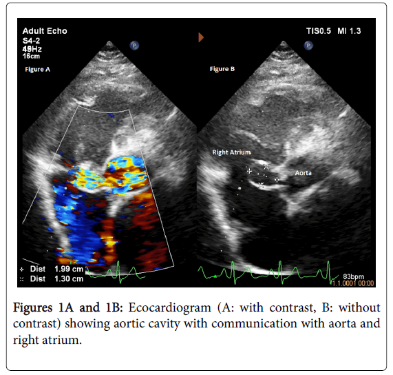 medical-implants-surgery-aortic-cavity