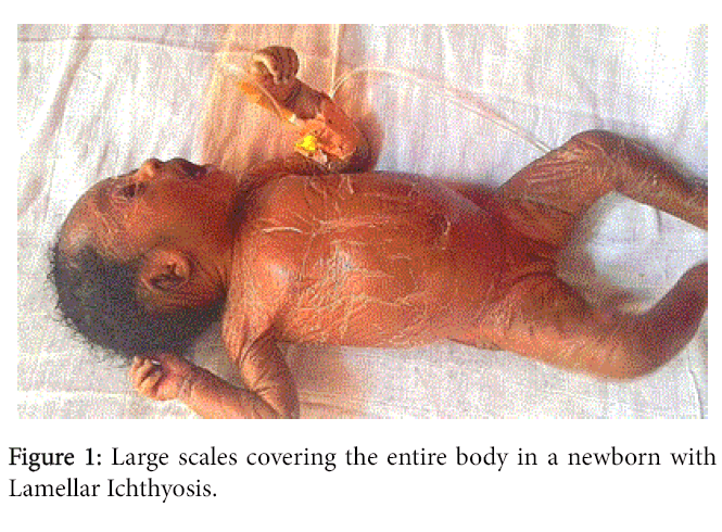 autosomal dominant lamellar ichthyosis in a cameroonian family