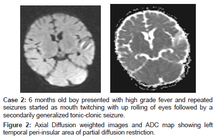 neuroinfectious-diseases-Axial-Diffusion