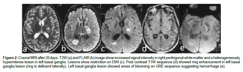 neuroinfectious-diseases-Left-basal-ganglia