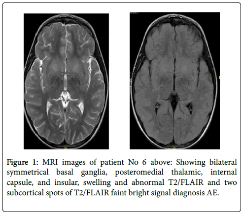 neuroinfectious-diseases-bilateral