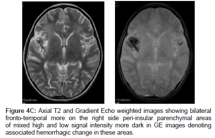 neuroinfectious-diseases-bilateral-fronto-temporal