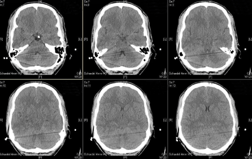 neuroinfectious-diseases-brain-edema