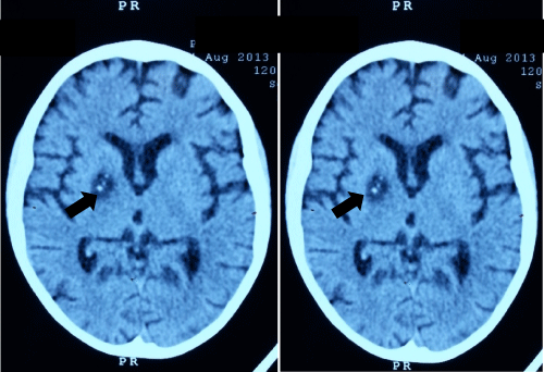 neuroinfectious-diseases-brain-lesion-scars