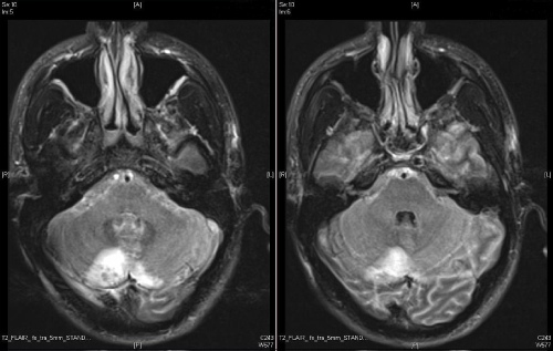 neuroinfectious-diseases-cerebellar-lesions