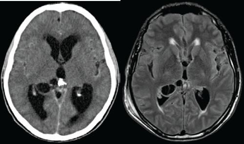neuroinfectious-diseases-cerebrospinal-fluid