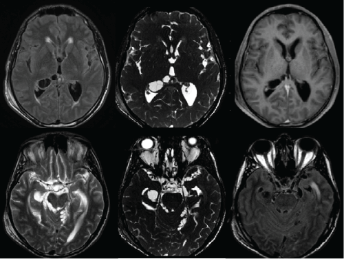 neuroinfectious-diseases-clusters-cystic-images