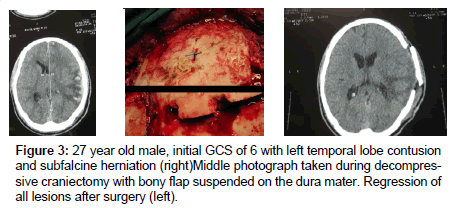 neuroinfectious-diseases-contusion-subfalcine