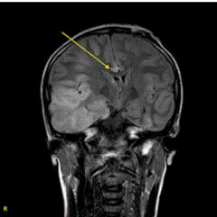 neuroinfectious-diseases-external-ventricular-drain