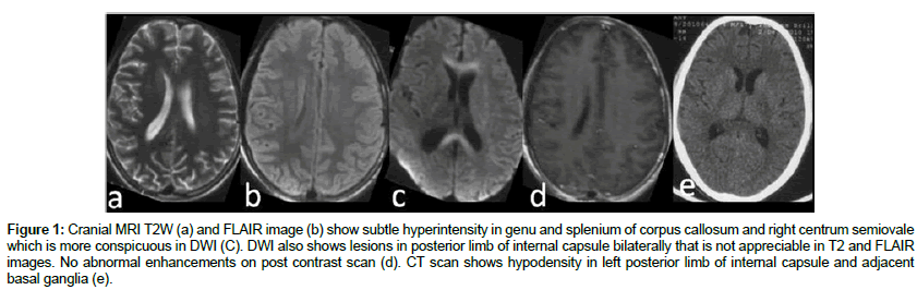 neuroinfectious-diseases-genu-splenium-corpus