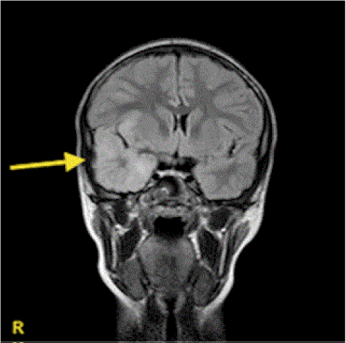 neuroinfectious-diseases-hyperintense