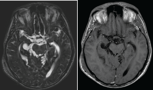 neuroinfectious-diseases-level-midbrain