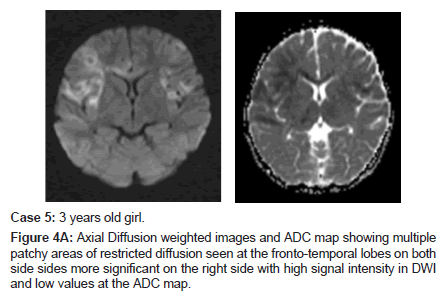 neuroinfectious-diseases-multiple-patchy-areas