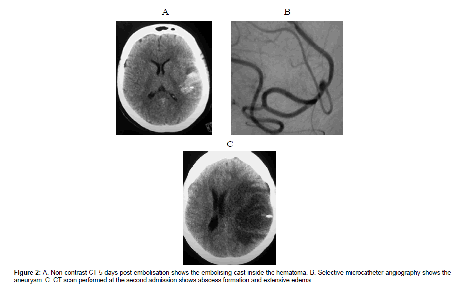 neuroinfectious-diseases-post-embolisation