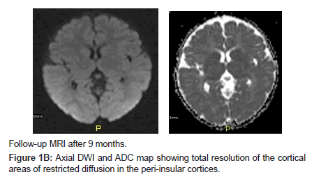 neuroinfectious-diseases-restricted-diffusion