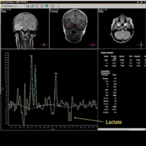 neuroinfectious-diseases-single-voxel-magnetic