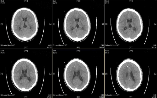 neuroinfectious-diseases-ventricular