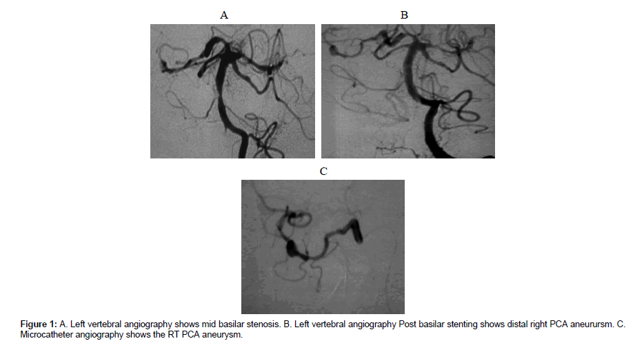 neuroinfectious-diseases-vertebral-angiography
