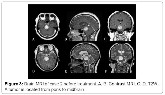 neurological-disorders-Brain-MRI