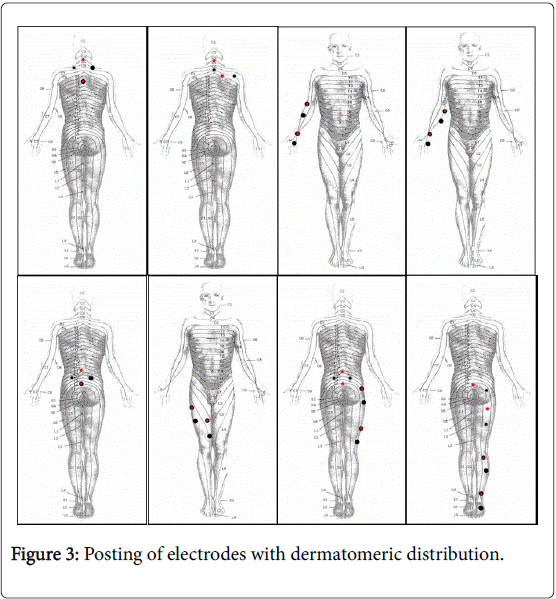 novel-physiotherapies-Posting-electrodes