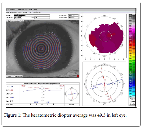 optometry-keratometric-diopter