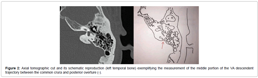 otolaryngology-Axial-tomographic
