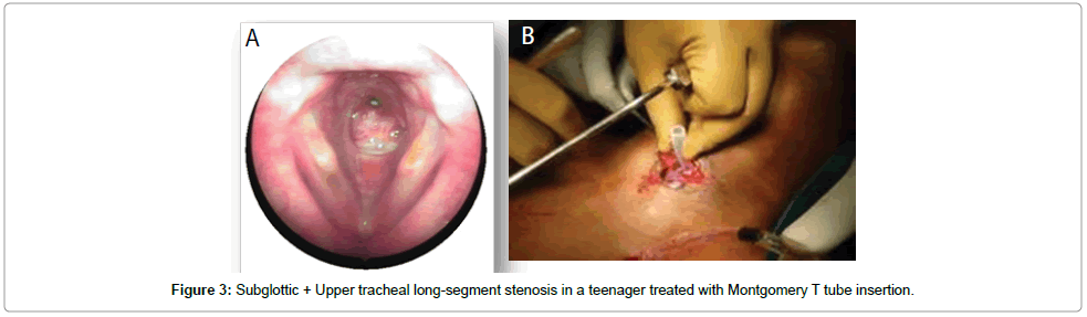 otolaryngology-Upper-tracheal