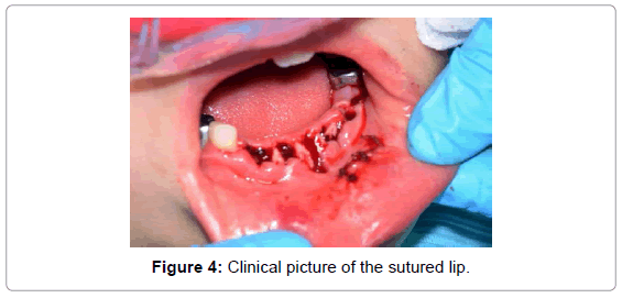 pediatric-dental-care-clinical-picture-sutured-lip