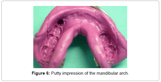 pediatric-dental-care-putty-impression-mandibular-arch