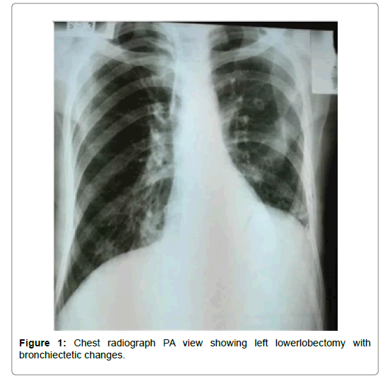 Bronchiolitis Chest X Ray