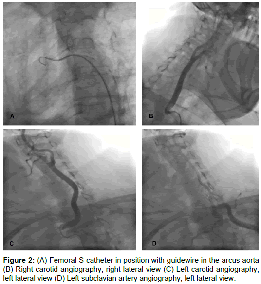 radiology-Left-subclavian-artery
